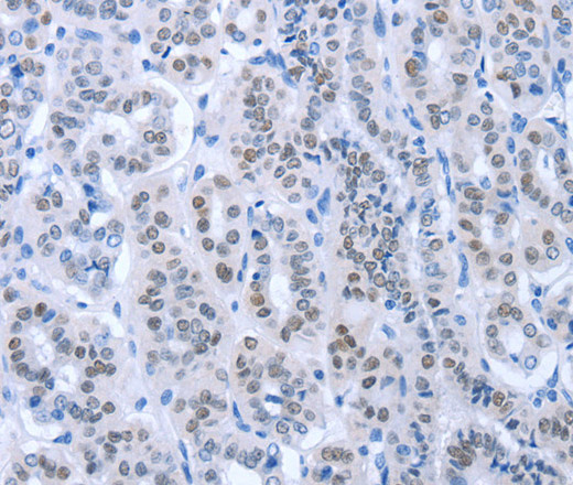 Immunohistochemistry of paraffin-embedded Human thyroid cancer using PAX8 Polyclonal Antibody at dilution of 1:35