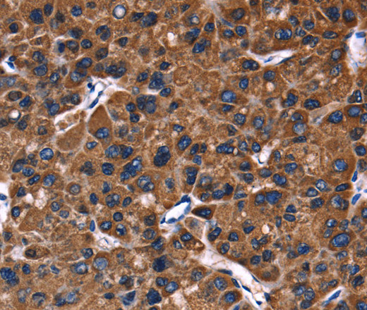 Immunohistochemistry of paraffin-embedded Human liver cancer using PHB Polyclonal Antibody at dilution of 1:30