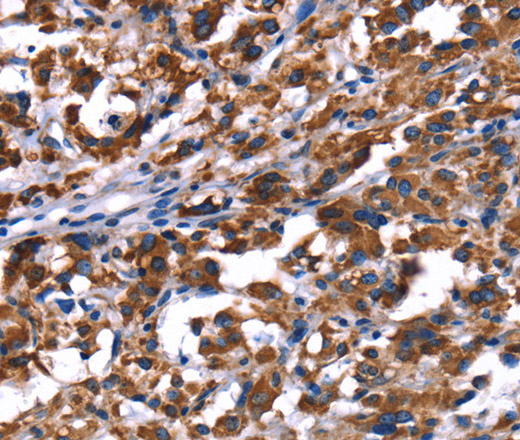 Immunohistochemistry of paraffin-embedded Human thyroid cancer using PHB Polyclonal Antibody at dilution of 1:30