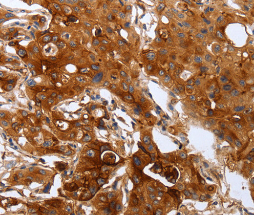 Immunohistochemistry of paraffin-embedded Human lung cancer using PLAUR Polyclonal Antibody at dilution of 1:60