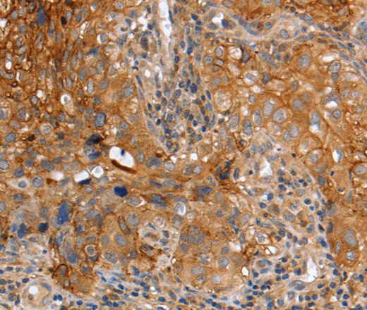 Immunohistochemistry of paraffin-embedded Human cervical cancer using PLAUR Polyclonal Antibody at dilution of 1:60