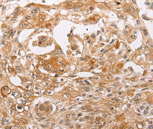 Immunohistochemistry of paraffin-embedded Human cervical cancer using PPP1CB Polyclonal Antibody at dilution of 1:30