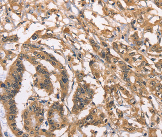 Immunohistochemistry of paraffin-embedded Human colon cancer using PEBP1 Polyclonal Antibody at dilution of 1:40