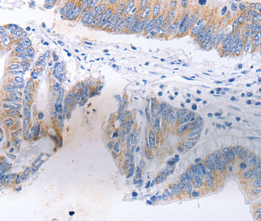 Immunohistochemistry of paraffin-embedded Human colon cancer tissue using SERP1 Polyclonal Antibody at dilution 1:30