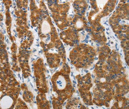 Immunohistochemistry of paraffin-embedded Human thyroid cancer tissue using PRDX5 Polyclonal Antibody at dilution 1:40