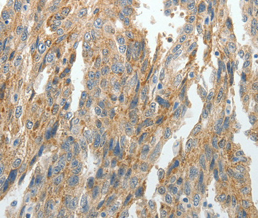 Immunohistochemistry of paraffin-embedded Human ovarian cancer tissue using PRDX5 Polyclonal Antibody at dilution 1:40