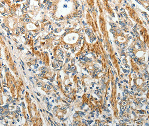 Immunohistochemistry of paraffin-embedded Human gastric cancer using E-Selectin Polyclonal Antibody at dilution of 1:40