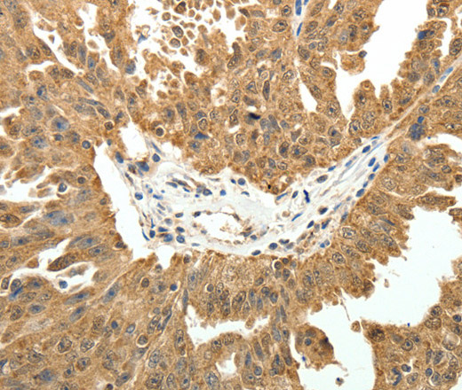 Immunohistochemistry of paraffin-embedded Human ovarian cancer using PTCH1 Polyclonal Antibody at dilution of 1:50