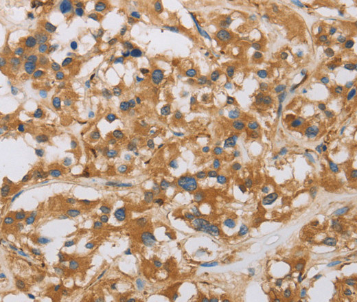 Immunohistochemistry of paraffin-embedded Human thyroid cancer tissue using RAD54L2 Polyclonal Antibody at dilution 1:40