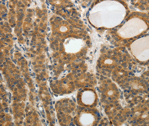 Immunohistochemistry of paraffin-embedded Human thyroid cancer tissue using RARA Polyclonal Antibody at dilution 1:40