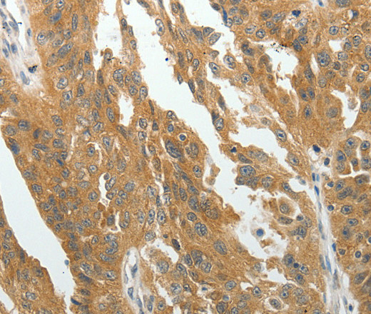 Immunohistochemistry of paraffin-embedded Human ovarian cancer tissue using RARA Polyclonal Antibody at dilution 1:40