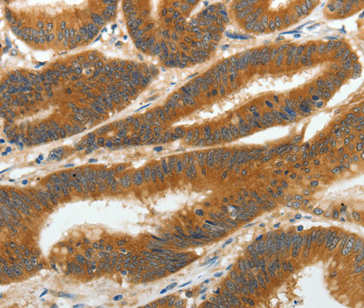 Immunohistochemistry of paraffin-embedded Human colon cancer tissue using RGS2 Polyclonal Antibody at dilution 1:40