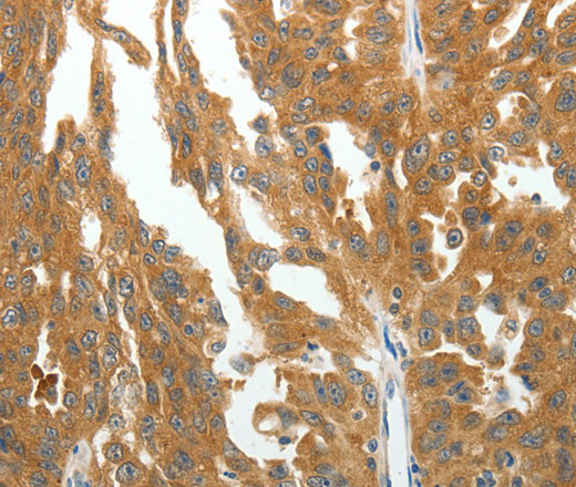 Immunohistochemistry of paraffin-embedded Human ovarian cancer tissue using RGS2 Polyclonal Antibody at dilution 1:40