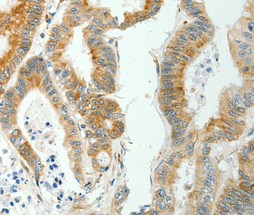 Immunohistochemistry of paraffin-embedded Human colon cancer tissue using SELENOM Polyclonal Antibody at dilution 1:50