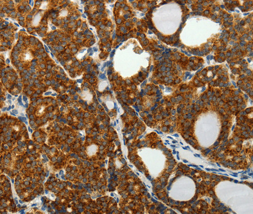 Immunohistochemistry of paraffin-embedded Human thyroid cancer tissue using SELENOM Polyclonal Antibody at dilution 1:50