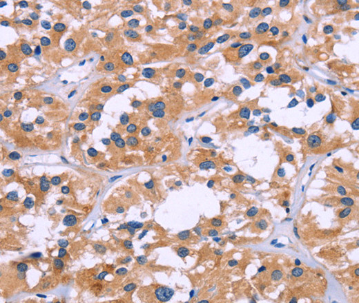 Immunohistochemistry of paraffin-embedded Human thyroid cancer tissue using ZEB2 Polyclonal Antibody at dilution 1:60