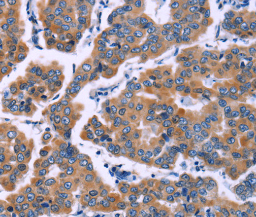 Immunohistochemistry of paraffin-embedded Human breast cancer tissue using ZEB2 Polyclonal Antibody at dilution 1:60