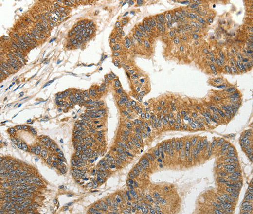 Immunohistochemistry of paraffin-embedded Human colon cancer tissue using SLC4A4 Polyclonal Antibody at dilution 1:50