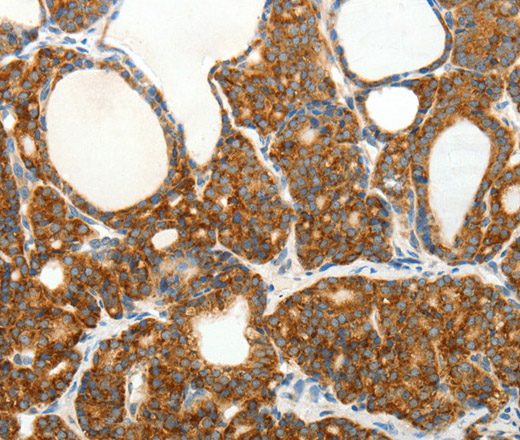 Immunohistochemistry of paraffin-embedded Human thyroid cancer tissue using SLC12A4 Polyclonal Antibody at dilution 1:30