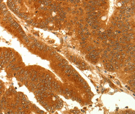 Immunohistochemistry of paraffin-embedded Human colon cancer using NAPA Polyclonal Antibody at dilution of 1:35