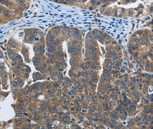Immunohistochemistry of paraffin-embedded Human ovarian cancer tissue using SYT3 Polyclonal Antibody at dilution 1:40