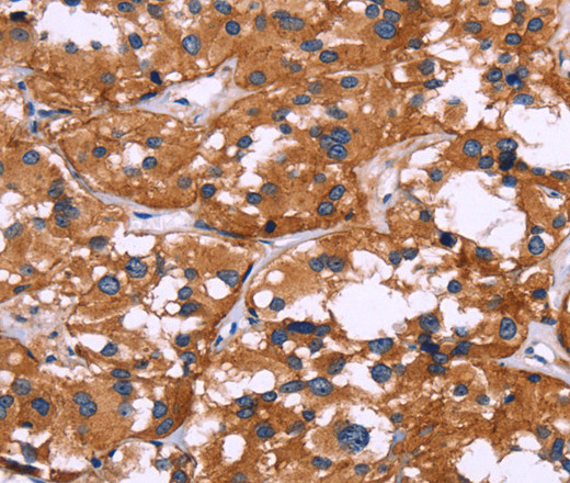 Immunohistochemistry of paraffin-embedded Human thyroid cancer tissue using SYT4 Polyclonal Antibody at dilution 1:60