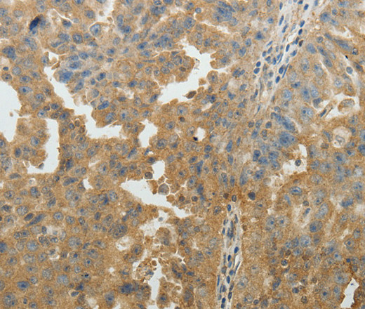 Immunohistochemistry of paraffin-embedded Human ovarian cancer tissue using SYT6 Polyclonal Antibody at dilution 1:40