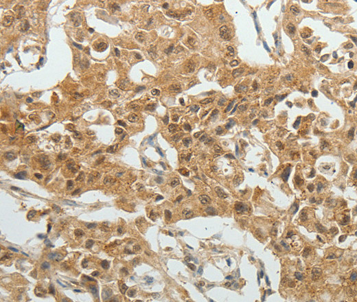 Immunohistochemistry of paraffin-embedded Human lung cancer tissue using SYT6 Polyclonal Antibody at dilution 1:40