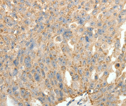 Immunohistochemistry of paraffin-embedded Human ovarian cancer tissue using SYT11 Polyclonal Antibody at dilution 1:30