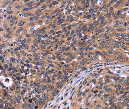 Immunohistochemistry of paraffin-embedded Human cervical cancer tissue using SPATA7 Polyclonal Antibody at dilution 1:30