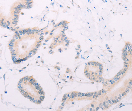 Immunohistochemistry of paraffin-embedded Human colon cancer tissue using MAP3K12 Polyclonal Antibody at dilution 1:30