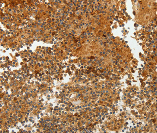 Immunohistochemistry of paraffin-embedded Human tonsil tissue using TFF2 Polyclonal Antibody at dilution 1:40