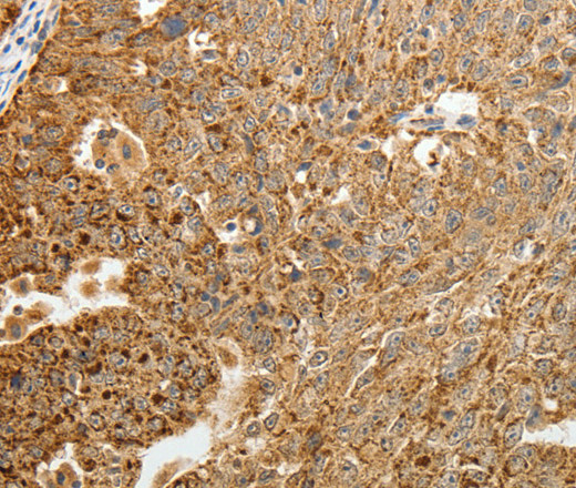 Immunohistochemistry of paraffin-embedded Human ovarian cancer tissue using TFF2 Polyclonal Antibody at dilution 1:40