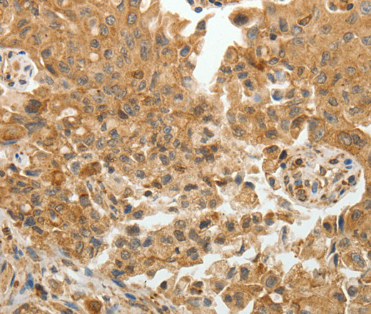 Immunohistochemistry of paraffin-embedded Human lung cancer tissue using TFPI2 Polyclonal Antibody at dilution 1:30