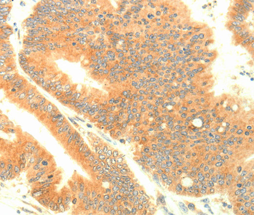 Immunohistochemistry of paraffin-embedded Human colon cancer using TRAF3IP2 Polyclonal Antibody at dilution of 1:30