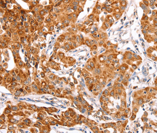Immunohistochemistry of paraffin-embedded Human lung cancer using TRAF5 Polyclonal Antibody at dilution of 1:30
