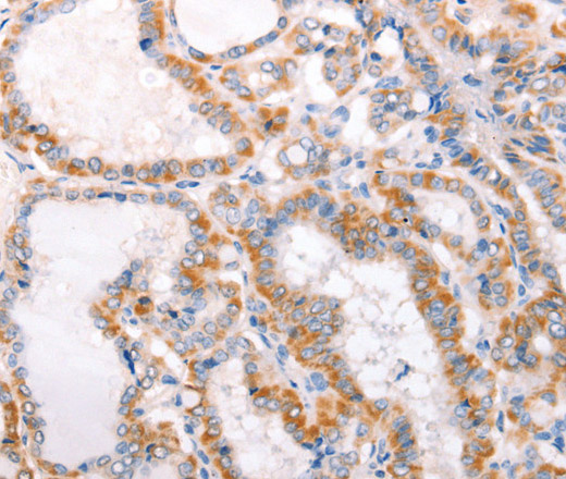 Immunohistochemistry of paraffin-embedded Human thyroid cancer using TRAF5 Polyclonal Antibody at dilution of 1:30