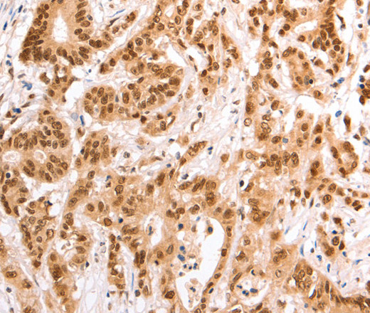 Immunohistochemistry of paraffin-embedded Human colon cancer tissue using TAX1BP1 Polyclonal Antibody at dilution 1:60