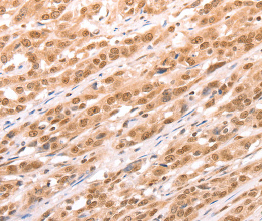 Immunohistochemistry of paraffin-embedded Human esophagus cancer tissue using TAX1BP1 Polyclonal Antibody at dilution 1:60