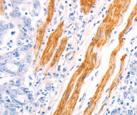 Immunohistochemistry of paraffin-embedded Human gastric cancer using TPM1 Polyclonal Antibody at dilution of 1:40