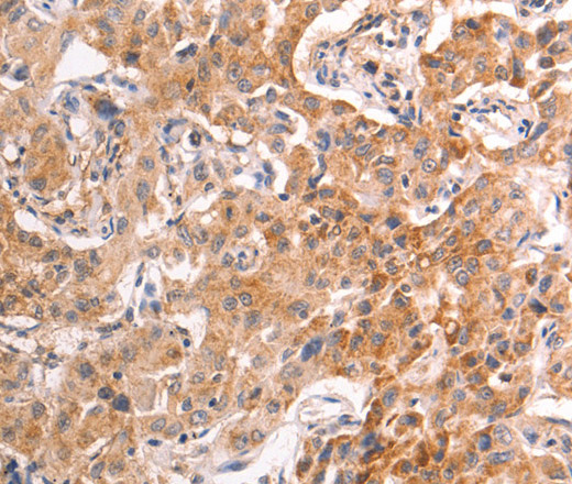 Immunohistochemistry of paraffin-embedded Human liver cancer tissue using TRPV4 Polyclonal Antibody at dilution 1:40