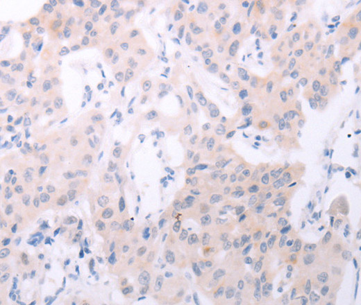 Immunohistochemistry of paraffin-embedded Human lung cancer tissue using SPATA6 Polyclonal Antibody at dilution 1:50