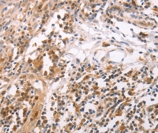 Immunohistochemistry of paraffin-embedded Human cervical cancer tissue using CIDEB Polyclonal Antibody at dilution 1:50