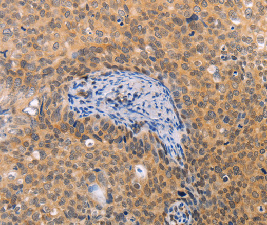 Immunohistochemistry of paraffin-embedded Human cervical cancer tissue using pVHL Polyclonal Antibody at dilution 1:40