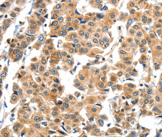 Immunohistochemistry of paraffin-embedded Human breast cancer tissue using XBP1 Polyclonal Antibody at dilution 1:60