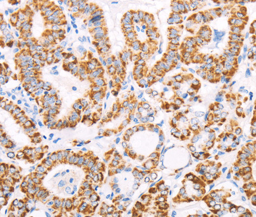 Immunohistochemistry of paraffin-embedded Human thyroid cancer using ATPIF1 Polyclonal Antibody at dilution of 1:50