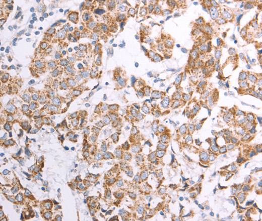 Immunohistochemistry of paraffin-embedded Human breast cancer using ATPIF1 Polyclonal Antibody at dilution of 1:50