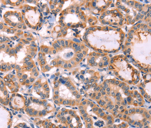 Immunohistochemistry of paraffin-embedded Human thyroid cancer tissue using PROS1 Polyclonal Antibody at dilution 1:60