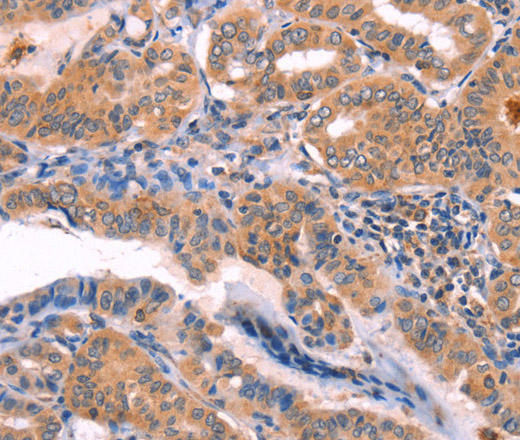 Immunohistochemistry of paraffin-embedded Human thyroid cancer using NCEH1 Polyclonal Antibody at dilution of 1:80