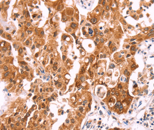 Immunohistochemistry of paraffin-embedded Human lung cancer using NCEH1 Polyclonal Antibody at dilution of 1:80